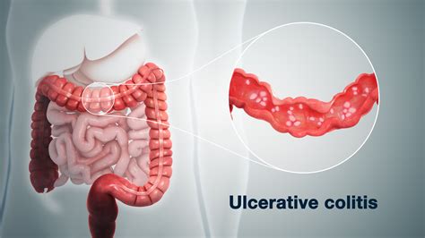 Ulcerative Colitis Causes Treatment Depicted Using D Medical Aniamion