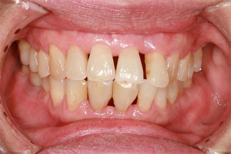 Periodontitis Treatment Home Remedies And Symptoms