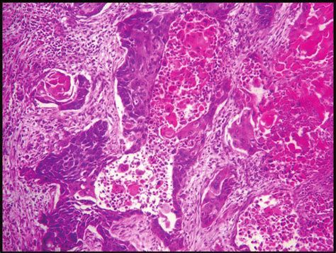 Keratinizing Squamous Cell Carcinoma Of The Lung Hande 100× Download