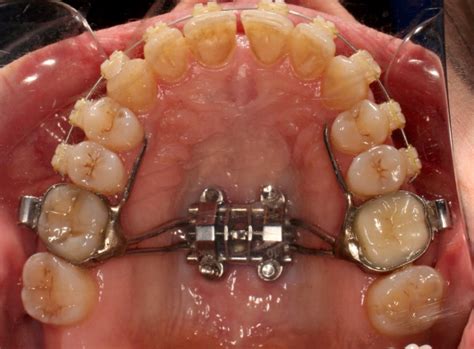 Maxillary Skeletal Expander Mse Lemke Orthodontics Sugar Land Houston Tx