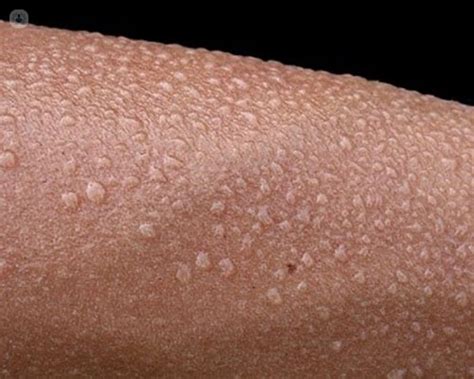 Excessive Sweating Could It Be Hyperhidrosis