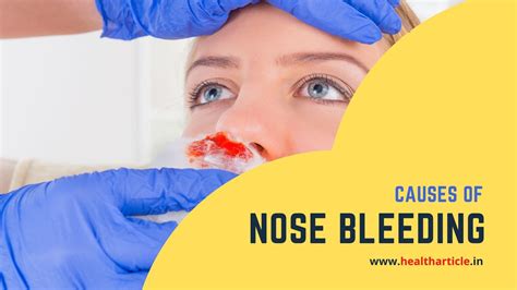 Nose Bleeding Treatment Causes First Aid Treatment