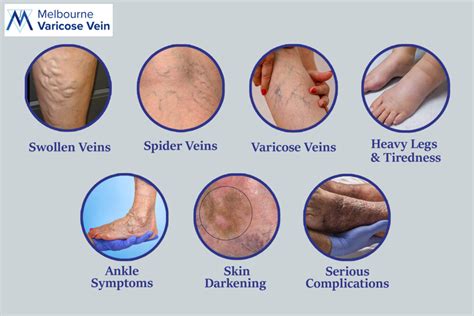 Painful Vein Problems Melbourne Varicose Vein Clinic