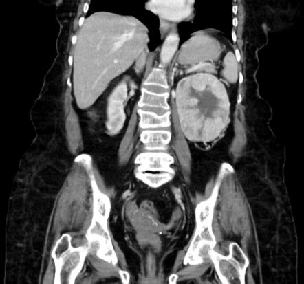 Renal Cell Carcinoma Tnm Staging Radiology Reference Article