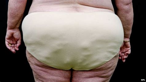 Women Have More Obesity Treatment Bbc News