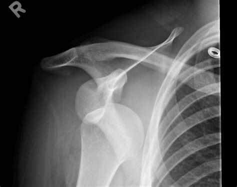 Shoulder dislocations account for 50 percent of all major joint dislocations. Clinical Sonography Ottawa: POCUS guided Shoulder Reduction