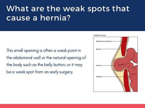 5 Frequently Asked Question And Answers About Hernia