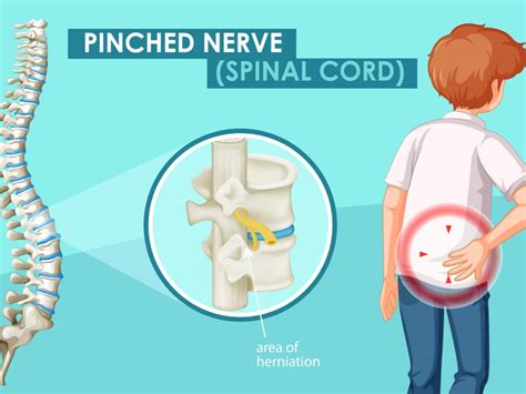 how do you fix a pinched nerve in your back metro health nyc