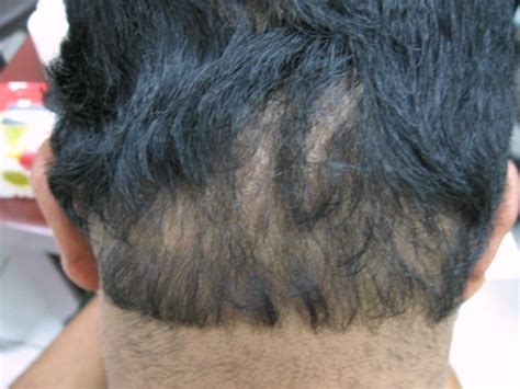 It may be congenital or acquired, circumscribed or diffuse, and cicatricial or nonscarring. Alopecia Areata (Ophiasis) - Dermatologists Sans Borders