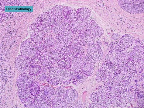 All Sizes Qiao S Pathology Lobular Carcinoma In Situ LCIS Flickr Photo Sharing