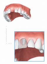 Photos of Emergency Dental Implants
