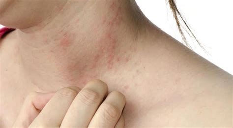 Dermatitis atópica la segunda enfermedad más diagnosticada del mundo Canal