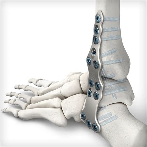 Lateral Ttc Fusion Plates Unite Foot And Ankle
