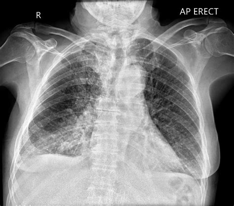 Chest X Ray Shows Pulmonary Edema Pleural Effusion And Mild My Xxx Hot Girl