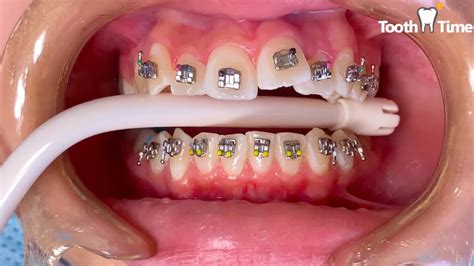 Orthodontist Putting On Braces