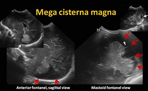 Cisterna Magna Ultrasound