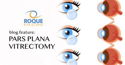 Pars Plana Vitrectomy Roque Eye Clinic Ph