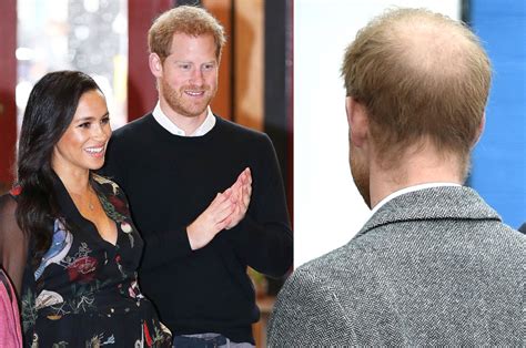 prince harry gained a wife but lost some hair page six