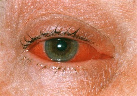 Viral Conjunctivitis Stock Image M1550439 Science Photo Library