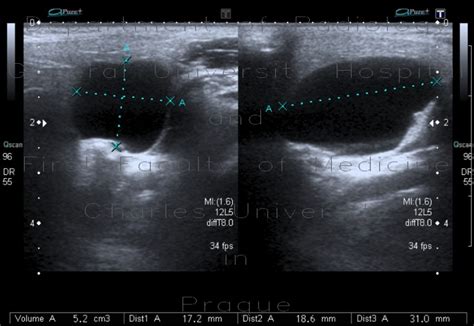 Radiology Case Branchial Cleft Cyst Parotid Gland