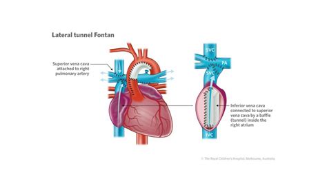 The Fontan Procedure Dr Kirsten Finucane Youtube