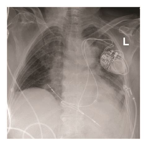 Chest X Ray Showing Final Position Of Pacemaker And Leads Download