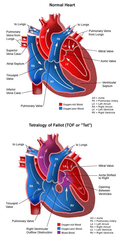 Tetralogy Of Fallot Congenital Heart Defects Childrens Hospital Of