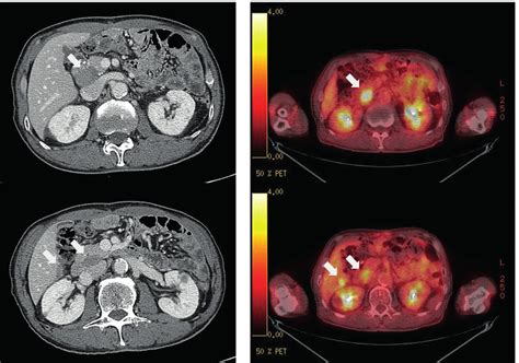 Ct And Pet Scans At First Recurrence To The Intra Abdominal Lns A Ct