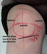 Knee Plica Treatment Pictures