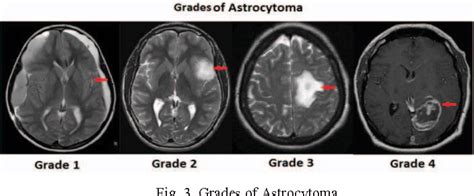 Grades Of Brain Tumors