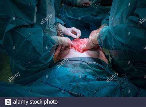 Abdominal Hernia High Resolution Stock Photography And Images Alamy