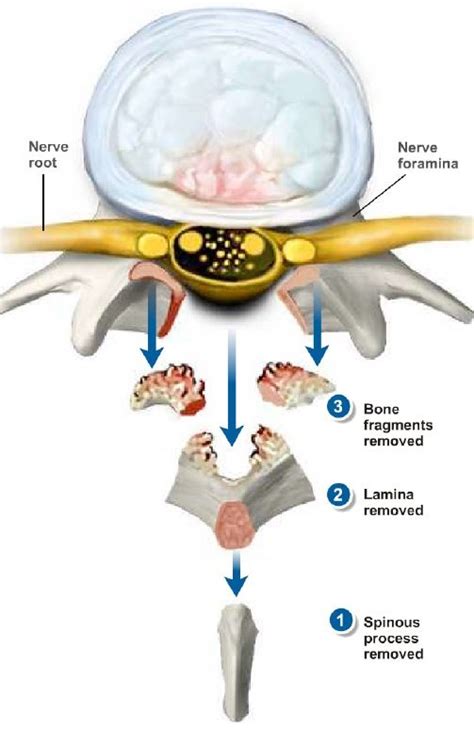 Lumbar Decompressionlaminectomy Endospine360