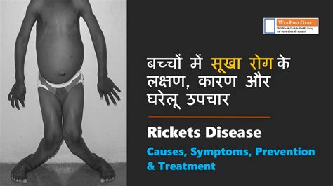 Rickets Disease बच्चों में सूखा रोग रिकेट्स के लक्षण कारण और घरेलू