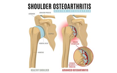 Shoulder Osteoarthritis Treatment Melbourne Hand Therapy
