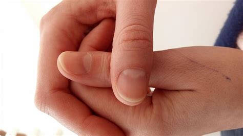 O czym świadczą pionowe prążki na paznokciach WIDEO WP abcZdrowie