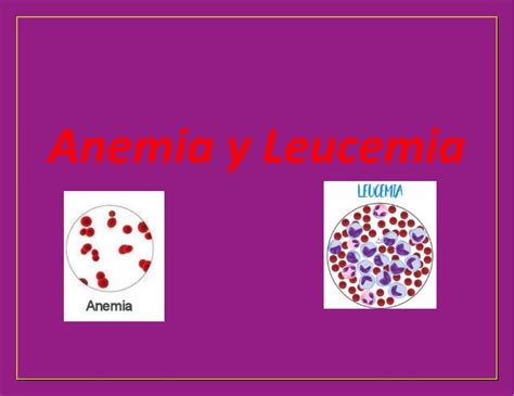 Resúmenes De Leucemia Descarga Apuntes De Leucemia