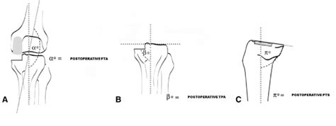 A C Postoperative Radiographic Measurements Of A Femorotibial Angle