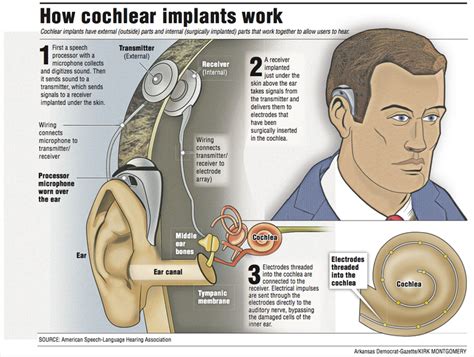 Cochlear Implants Give The T Of Hearing But They’re Not For Everyone Northwest Arkansas