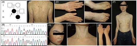 Two Novel Sash1 Mutations In Chinese Families With Dyschromatosis