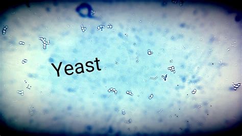 Candida Albicans Yeast In Urine Microscope And Gram Stain Youtube