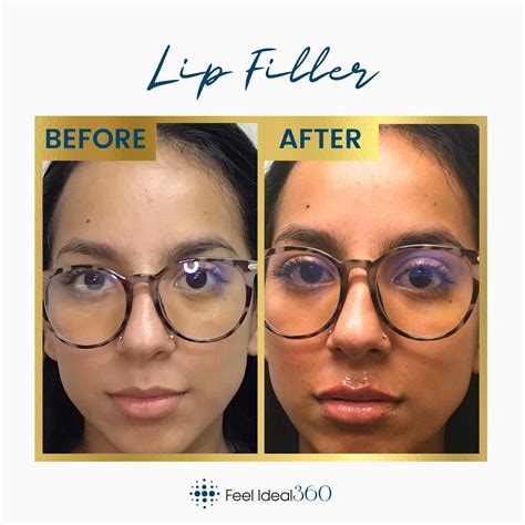 Lip Filler Before And After Feel Ideal 360 Med Spa Southlake Tx