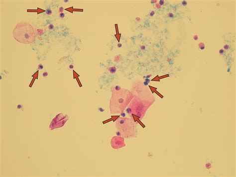 Red And White Blood Cells In Urine