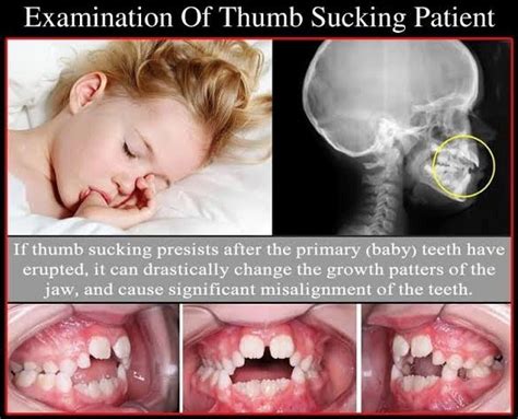 Thumb Sucking And Habit Correction Clinic Paradise Road Dental Practice