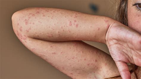What Are Some Common Allergic Reactions To Antibiotics Goodrx