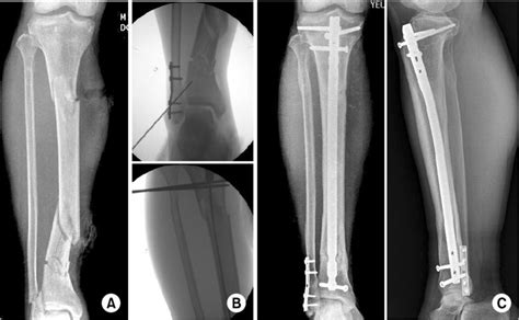 A A 54 Year Old Male Patient Segmental Tibial Fracture B Initial