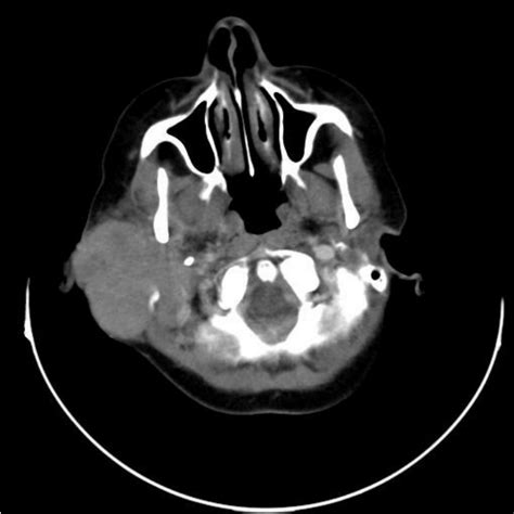 A Ct Scan Of The Head And Neck Showing A Tumour In The Right Parotid