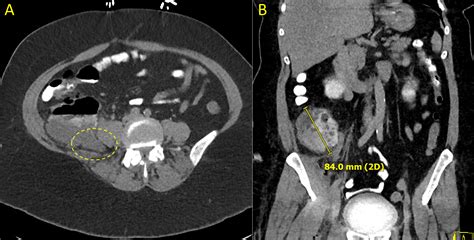 Cureus Perforated Appendicitis Presenting As A Soft Tissue Infection
