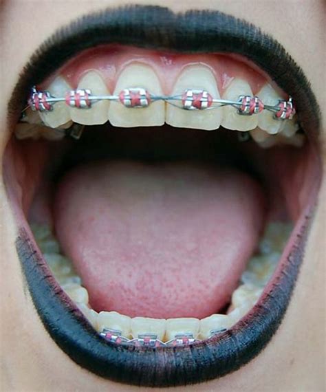 pink braces colors braces pinterest pink braces