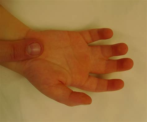 Partial Syndactyly Congenital Hand And Arm Differences
