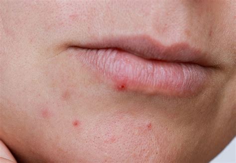 How To Get Rid Of Lip Pimples Cleveland Clinic